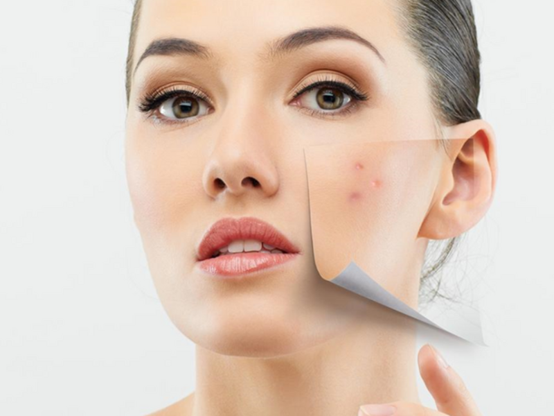 Mụn là gì? Phân biệt các loại mụn không viêm trên mặt